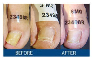getting rid of toenail fungus